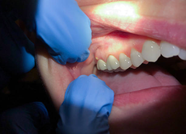 Best Emergency Tooth Extraction in Joseph, OR